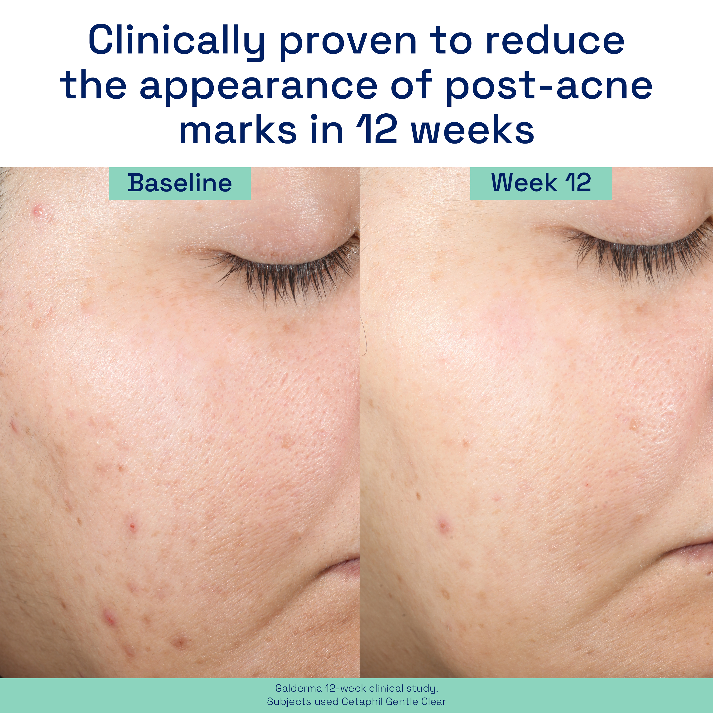 Gentle Clear Repairing Post-Acne Serum