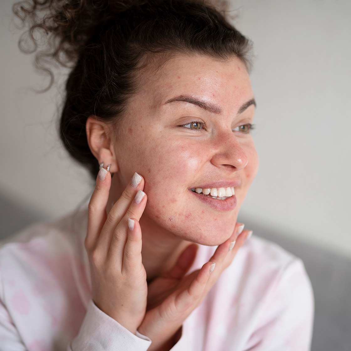Acne scars: causes and how to prevent & manage