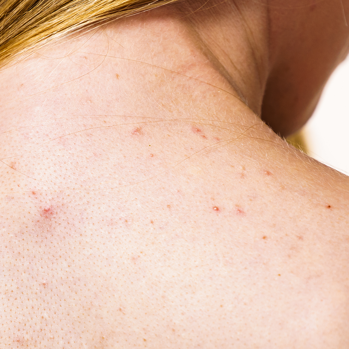 What is Body Acne, and How Can You Help Manage It?
