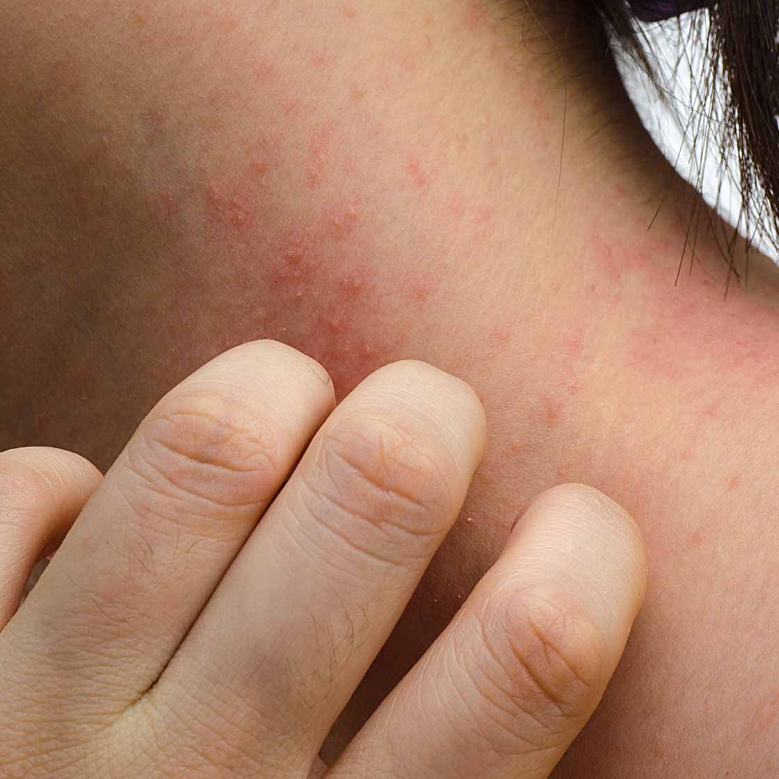 What Causes Eczema Flare-Ups?